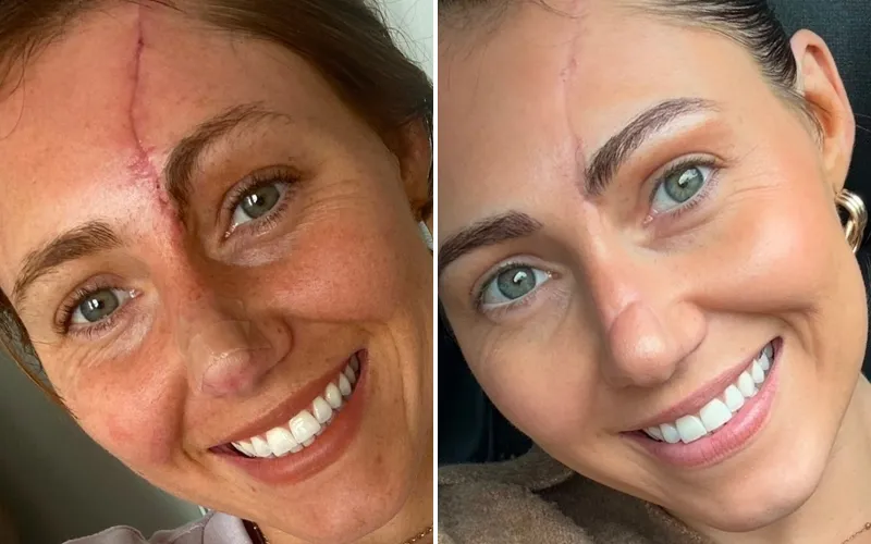 Red Light Therapy Mask Before And After